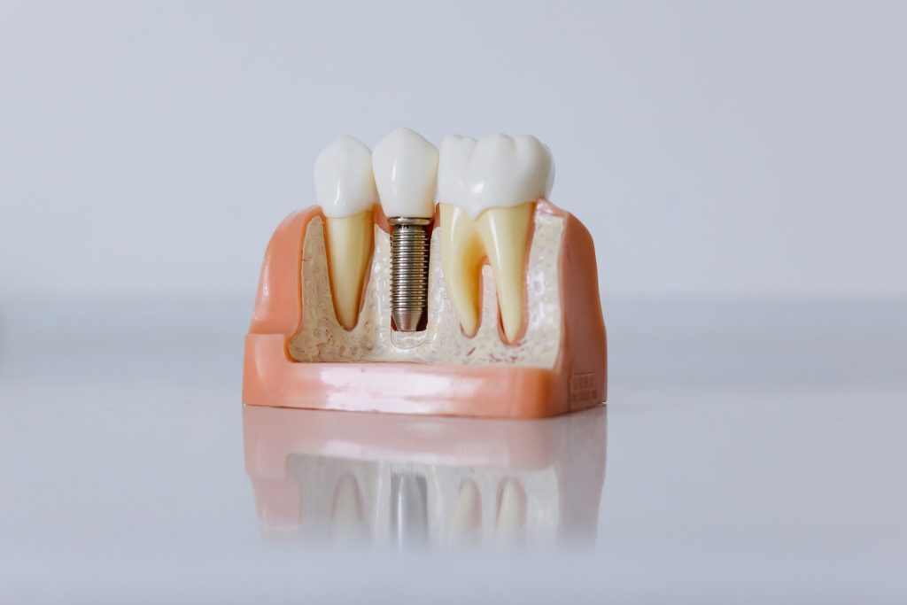 Phục hình bắt vít trên implant là phương pháp điều trị mất răng phổ biến và hiệu quả nhất hiện nay
