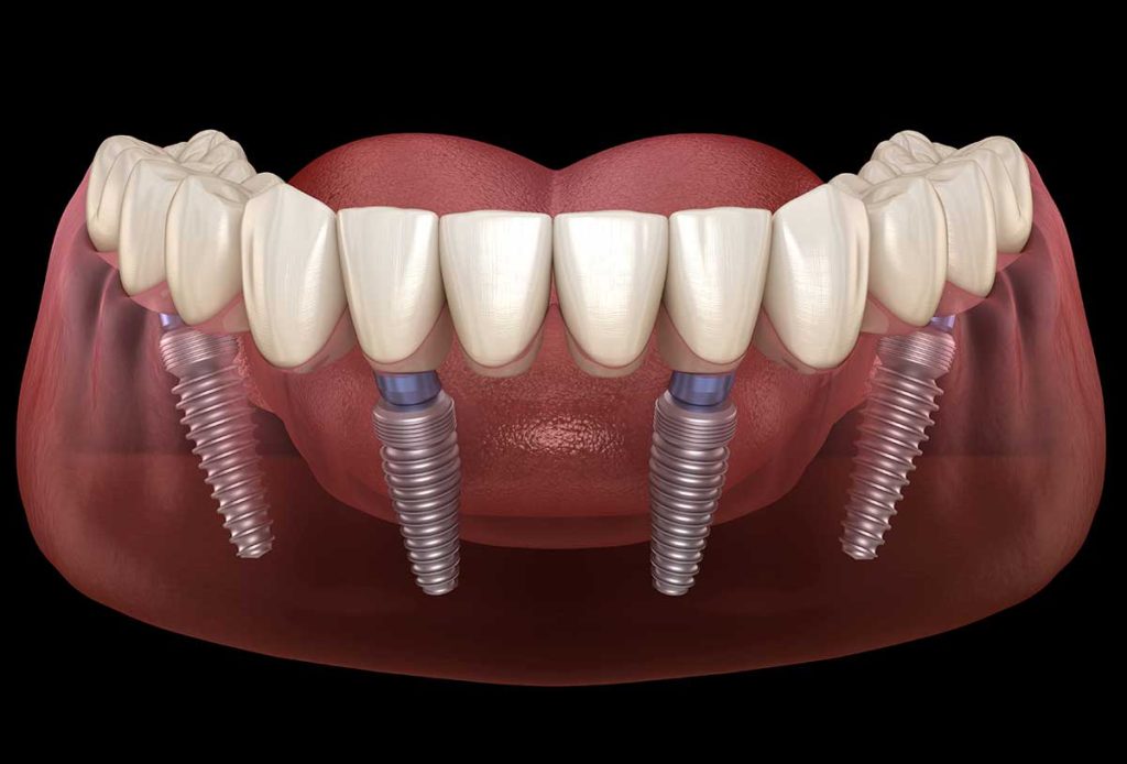 Phương pháp phục hình răng sứ trên Implant All on 4 