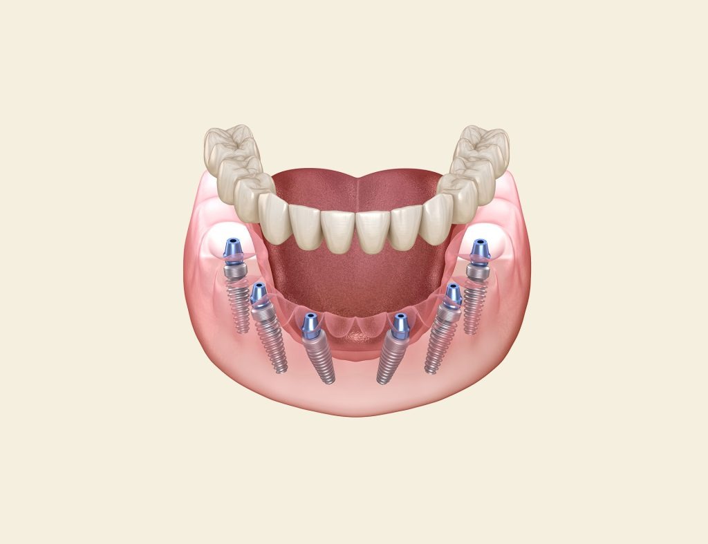 Phương pháp phục hình răng sứ trên Implant All on 6 