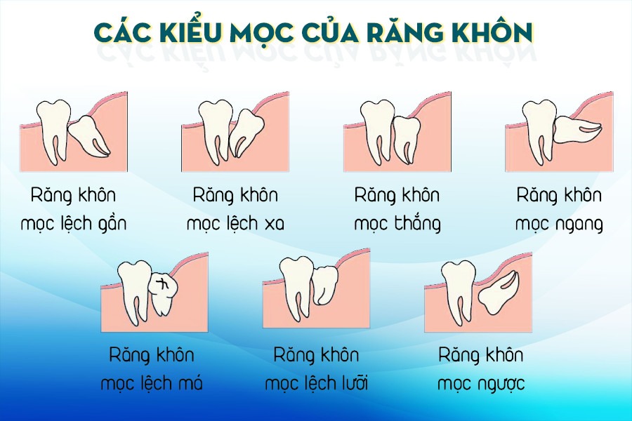 Răng khôn thường không mọc thẳng giống như những chiếc răng hàm khác 
