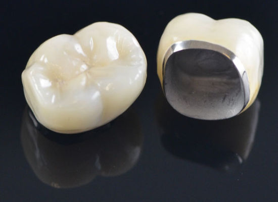 Thẩm mỹ răng sứ với răng sứ kim loại