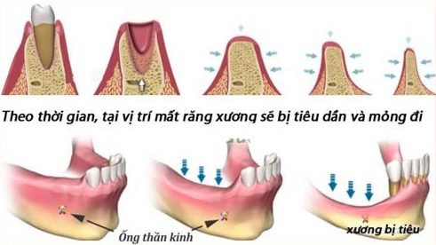 Tiêu xương hàm có trồng răng được không? Quá trình tiêu xương hàm khi bị mất răng 