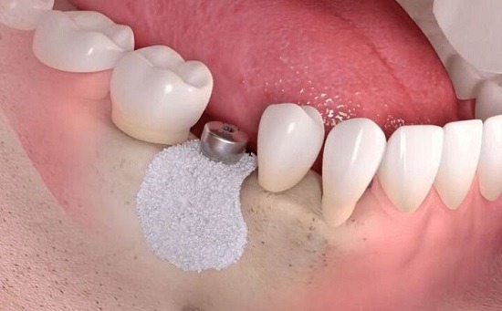 Tiêu xương hàm có trồng răng được không? Cấy ghép implant được thực hiện với người bệnh tiêu xương hàm 