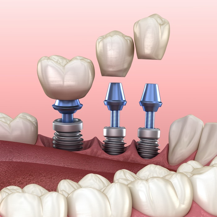 Trồng răng implant bao nhiêu tiền? Mức giá bạn phải chi trả cho một răng Implant thường là 20 đến 33 triệu 