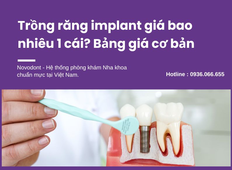 Implant được xem là phương pháp phục hình răng đã mất hiện đại nhất tính đến thời điểm hiện tại 