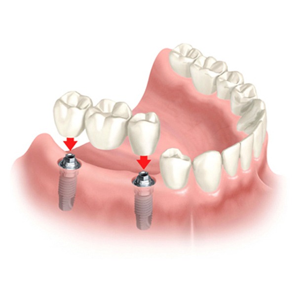 Trồng răng implant có vĩnh viễn không? Độ bền tùy thuộc vào nhiều yếu tố