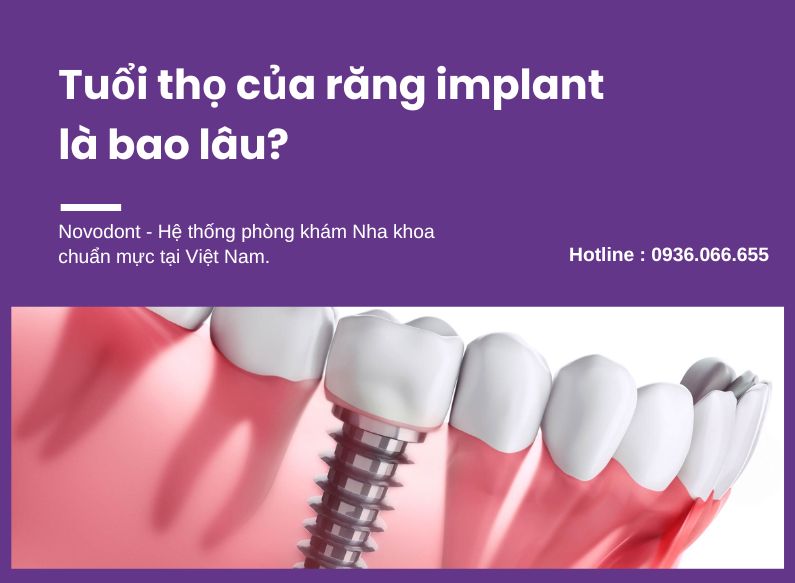 Trồng răng implant có vĩnh viễn không