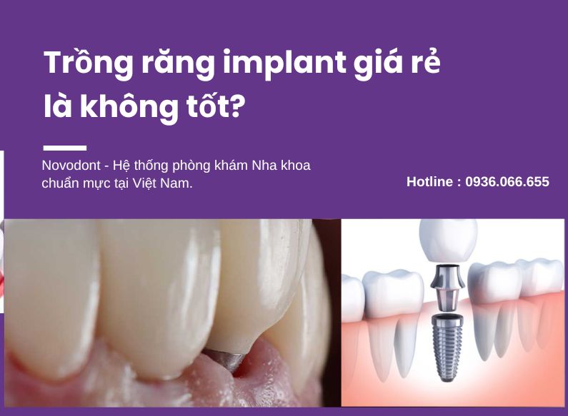 Trồng răng implant giá rẻ có tốt không?