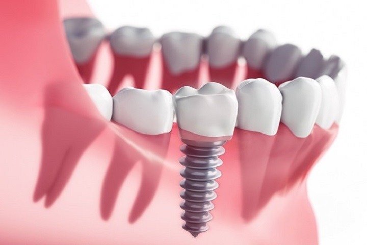 Trồng răng implant giá rẻ có thể do đã cắt giảm các chi phí khám trước và sau ghép implant