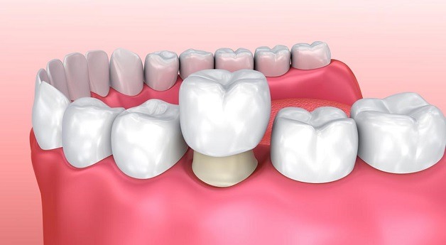 Bọc răng sứ nguyên hàm là giải pháp thẩm mỹ được nhiều khách hàng lựa chọn.