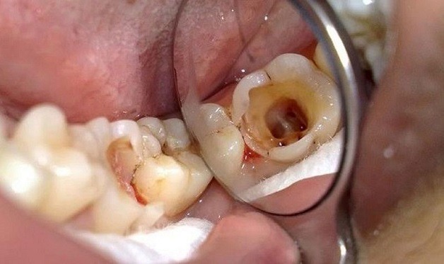 Trường hợp răng khôn bị sâu bắt buộc phải nhổ răng khôn