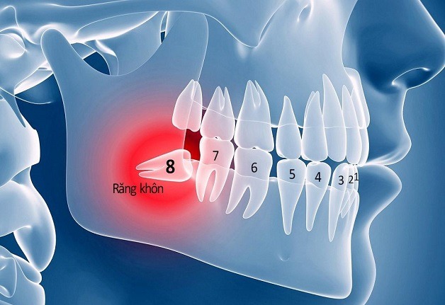 Trung bình 1 người trưởng thành có thể có từ 1 đến 4 răng khôn.