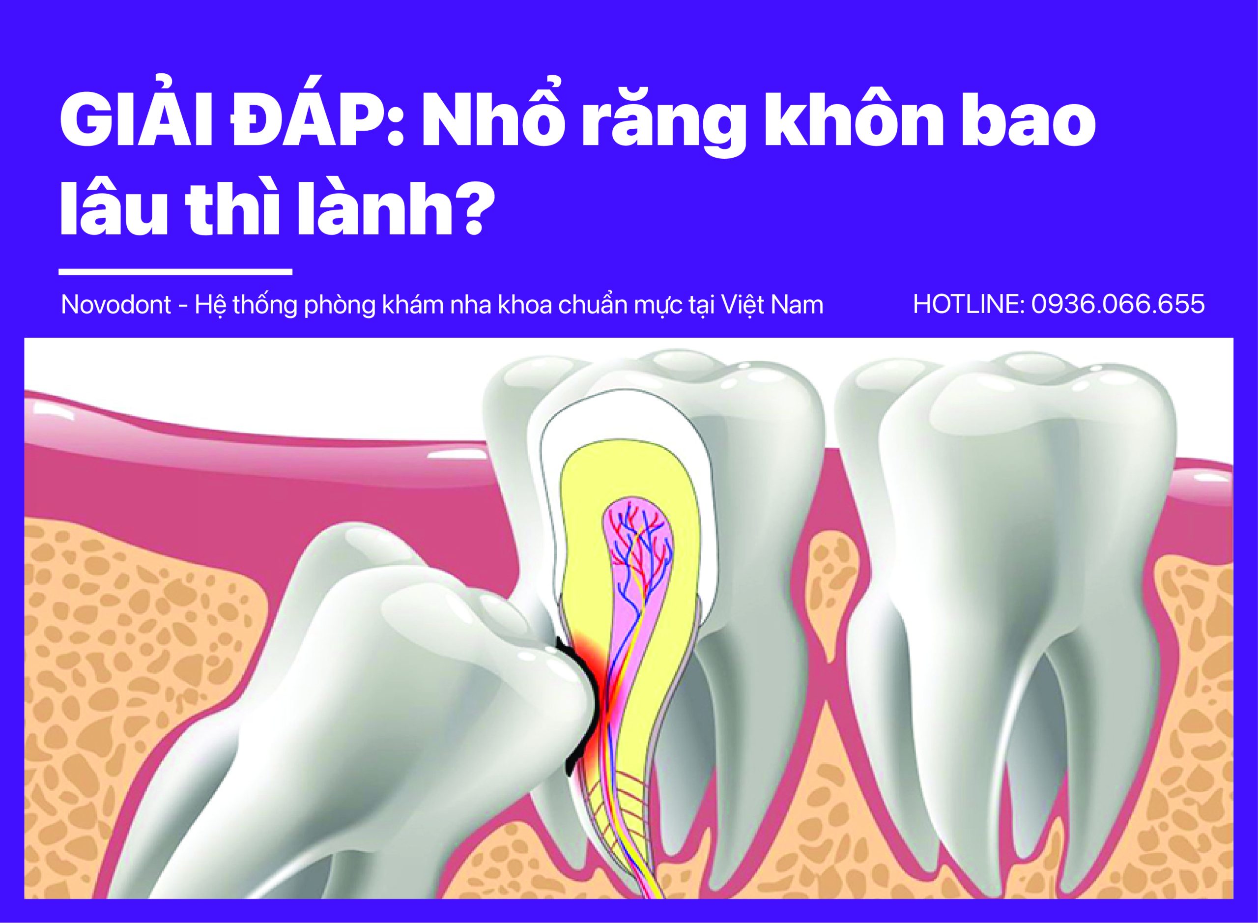 GIẢI ĐÁP: Nhổ răng khôn bao lâu thì lành? 