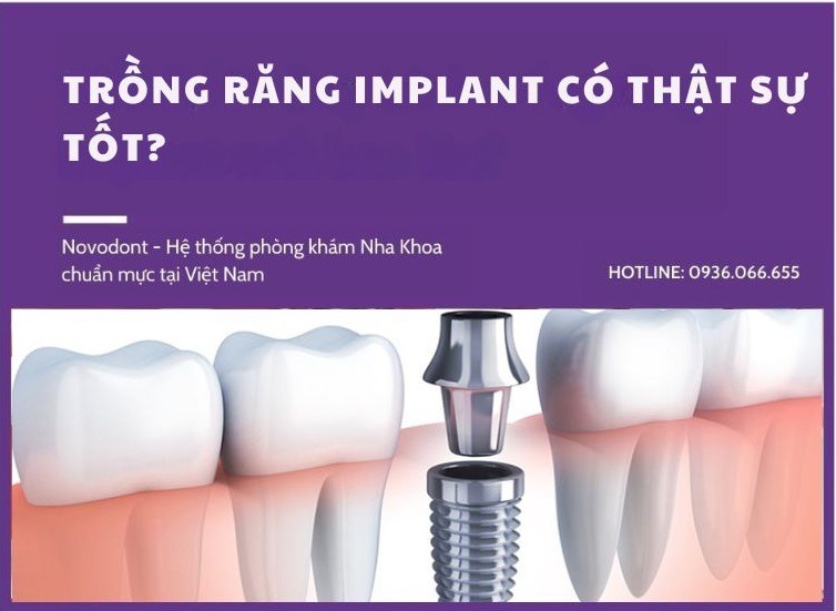 Trồng răng Implant có thật sự tốt?