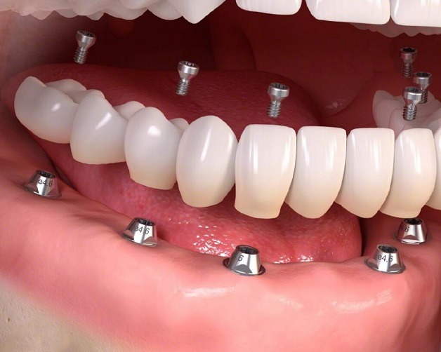 Trồng răng Implant là phương pháp được ưa chuộng bởi tính hiệu quả cao.