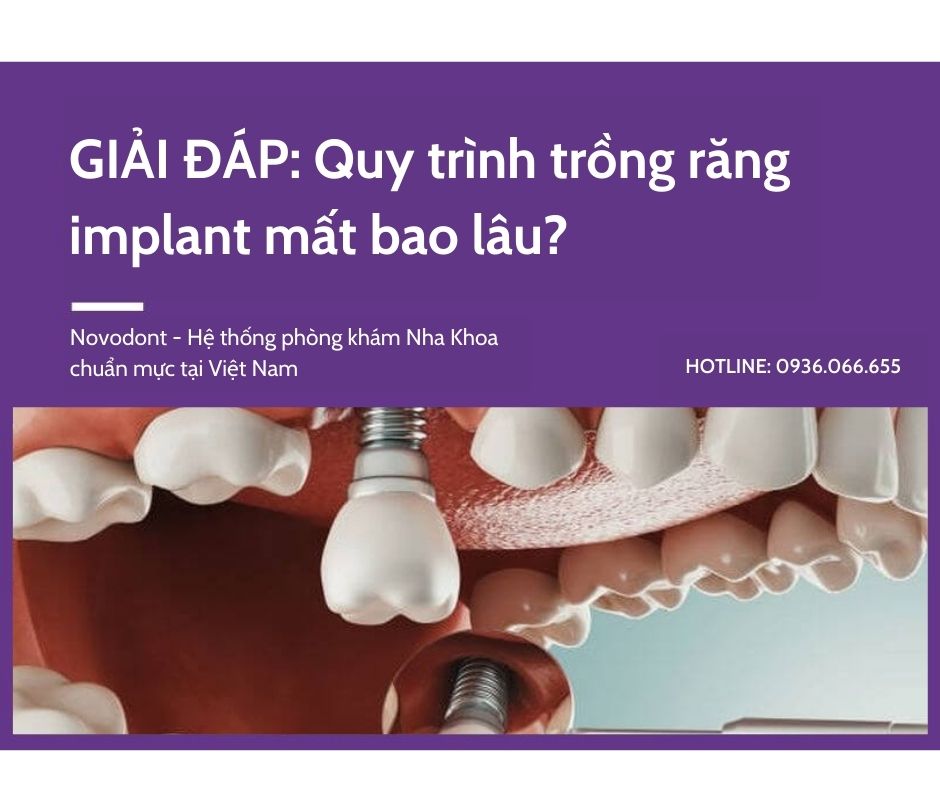 GIẢI ĐÁP: Quy trình trồng răng implant mất bao lâu?