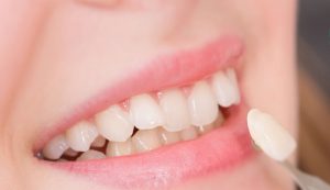 Bọc răng sứ không mài giúp bảo tồn tối đa răng thật