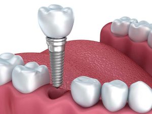 Trồng răng Implant là phương pháp ưu việt dành cho những trường hợp bị mất răng 
