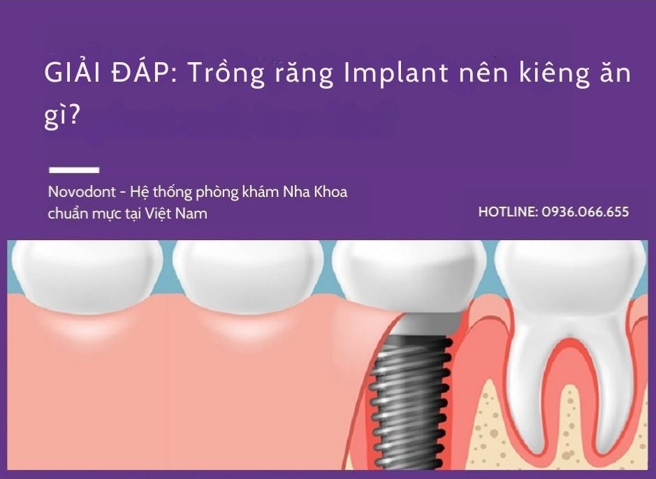 GIẢI PHÁP: Trồng răng Implant kiêng ăn gì? 