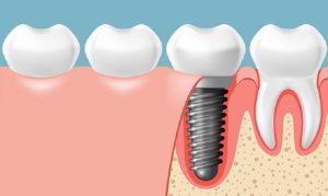 Trồng răng Implant là hình thức phục hồi răng mang lại hiệu quả cao.